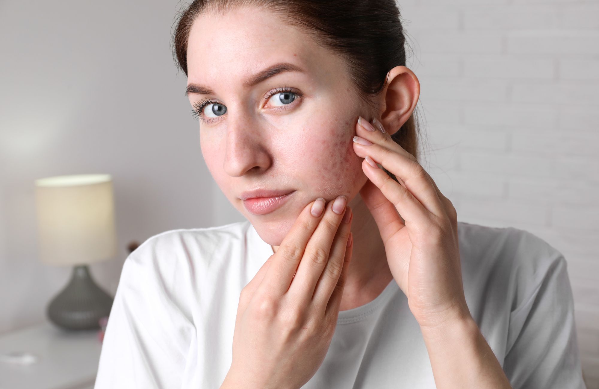 How To Get Rid Of Hormonal Acne For Good